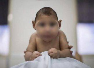 Otro bebito con microcefalia debido al zika en Yucatán