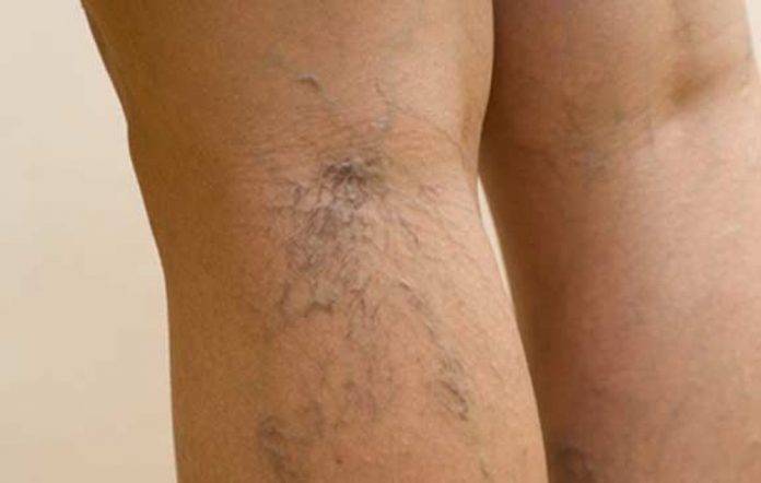 ¿Teines o conoces a alguien con várices? ésta es la solución natural