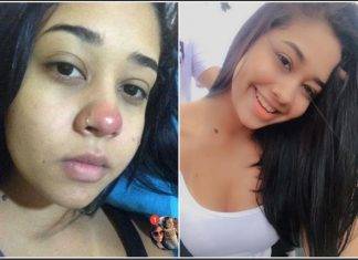Piercing en la nariz deja parapléjica a una chava de 20 años Piercing en la nariz deja parapléjica a una chava de 20 años