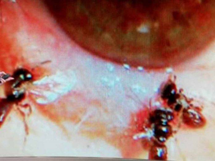 Va al doc por dolor en el ojo y le encuentra ¡4 abejas debajo del párpado!