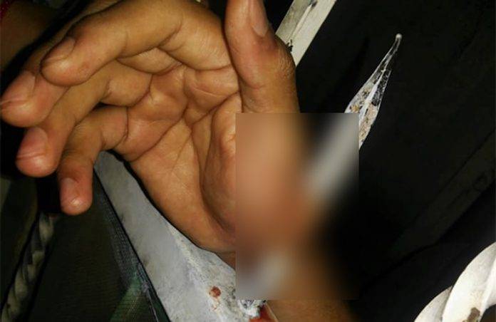 Tropieza y se ensarta la mano