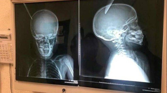 Niño de 8 años apuñala a otro chavito 5 años en la cabeza