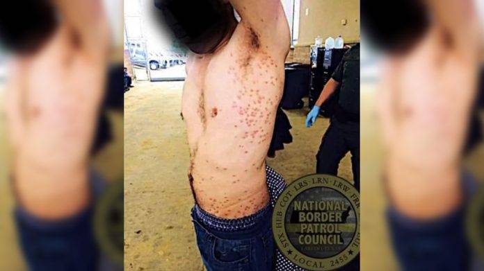 Alerta por detección de sarna en migrantes