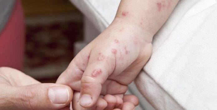 El virus Coxsackie podría estarse acercando a Yucatán