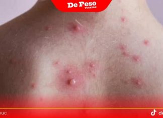 Aumentan casos de varicela en Yucatán