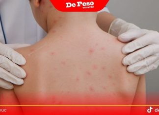 ¡A cuidarse! Por cada contagio de sarampión, puede haber 20 más