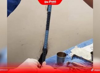 Salvan a niña yucateca: la operan y le sacan del estómago una impresionante bola de pelo