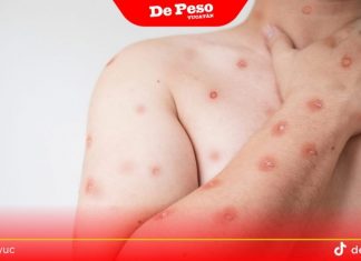 Confirman tercer caso de Mpox en Yucatán