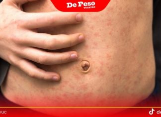Advierten que el brote de sarampión es consecuencia de la falta de vacunación