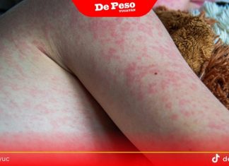Llamado urgente a la vacunación de sarampión; van 12 casos en Yucatán