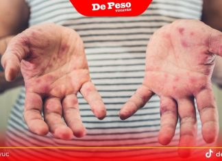 Confirman 23 casos de sarampión en Yucatán